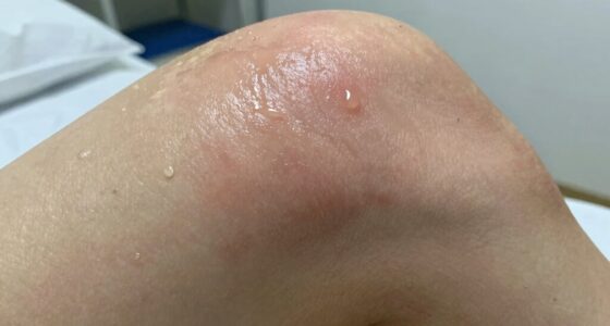 moisture increases pressure injury risk